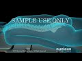If you like this animation, LIKE us on Facebook: www.nucleusinc.com Visit orthopedics.healthanimations.com for FREE videos, illustrations and patient handouts for healthcare providers. This 3D medical animation of back surgery shows lumbar spinal fusion, a surgical procedure performed on the spine to weld two or more vertebrae together using surgical hardware and bone graft material. Spinal fusions may be done to correct a number of conditions; a fractured vertebra, excessive motion between vertebra, spondylosis, spondylolisthesis, osteoarthritis, scoliosis or kyphosis and a bulging or herniated disc. ANH00015