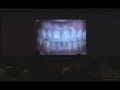 USC Dentistry: Periodontics & Implant Dentistry Symposium 2008 (Dr. K. Tsuchiya)The USC School of Dentistry's Office of Continuing Oral Health Professional Education (www.uscdentalce.org) has the mission of promoting excellent training and the highest standards of oral health care nationally and internationally. Through its state-of-the art program, the CE office offers a wide array of comprehensive courses and life-long learning experiences for general dentists, specialists and allied professionals.The lecture presented by Dr. Kenji Tsuchiya was part of the 33rd Annual USC Periodontal & Implant Symposium held in Los Angeles in 2008. Dr. Tsuchiya maintains a private practice focusing on prosthodontics, esthetic dentistry, periodontics and implantology in central Tokyo, Japan. He is the Founder of the Society of Japan Clinical Dentistry and Past-President of the Tokyo branch (1996 to 2004). This prestigious dental society in Japan has over 1,000 members. Dr. Tsuchiya is an active member of the Japanese Academy of Oral Implantology, Japanese Academy of Periodontics, Japanese Academy of Prosthodontics and Japanese Academy of Esthetic Dentistry. He has published numerous articles in the fields of esthetic dentistry and implantology. Dr. Tsuchiya has lectured extensively and has been directing a post-graduate course in Japan.For more information, or to order the entire presentation, please contact the USC Office of Continuing Oral Health Professional Education at 213-821-2127 or cedental@usc.edu, or visit www.uscdentalce.org (CE Store).