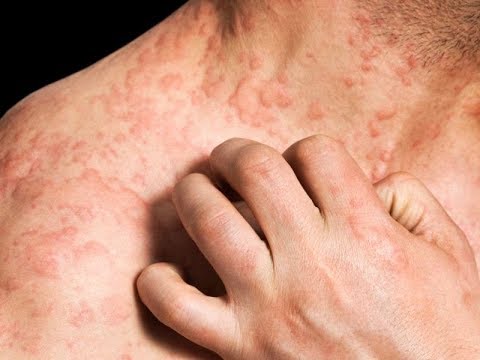 how to get rid of eczema naturally