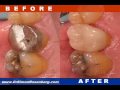 Cosmetic Dentistry Natural 1-Visit Porcelain Crowns/Veneers