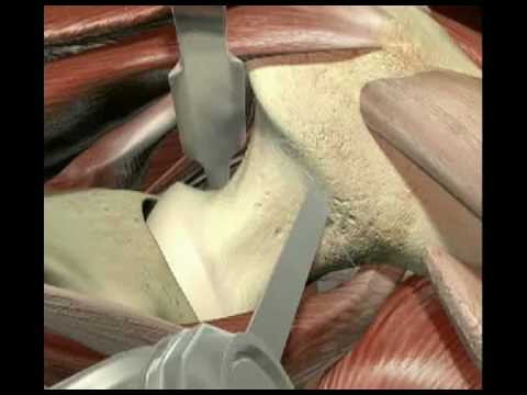 MicroHip total hip arthroplasty by Dr Markus C Michel