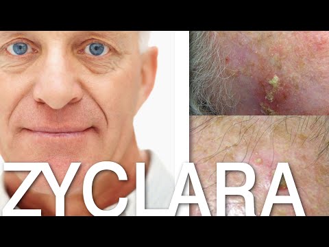 how to apply imiquimod
