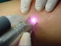 Tratamiento Laser contra las Varices