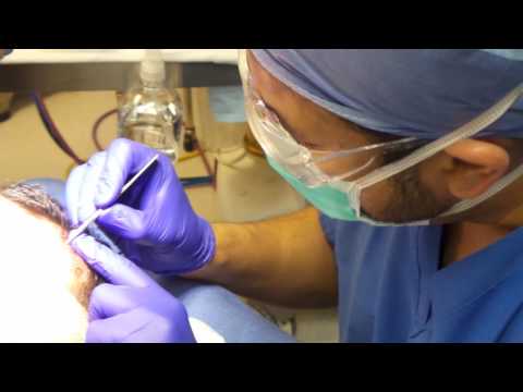 Dr. Shah Performs the NeoGraft