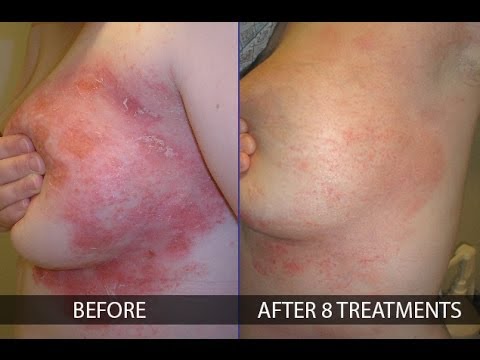 how to treat psoriasis