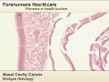Nasal cavity cancer treatment in India at best hospitals