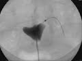 This patient had persistent fallopian tube blockage. A wire was passed into the fallopian - clearing the obstruction. A repeat selective salpingography demonstrated that the tube is now open.