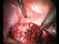 Laparoscopic treatment for intertitial ectopic pregnancy