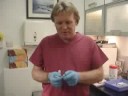 Radiesse for rejuvenating hands