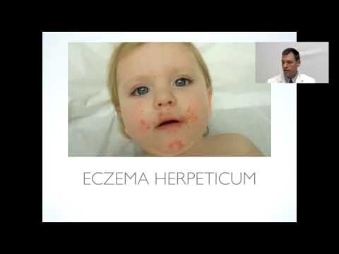 how to cure eczema on arms