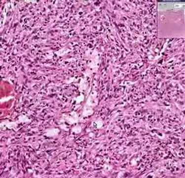 Histopathology Diaphragm--Metastatic ...