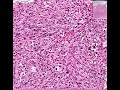 Histopathology Diaphragm--Metastatic liposarcoma