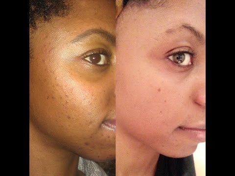 how to treat acne at home