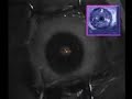 Keratoconus Treatment X Linking with PRK Keratoconus Treatment X Linking with PRK