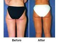Liposuction Dallas Surgeons Before After Pictures Liposuction Dallas Surgeons Before After Pictures
