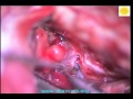 Neurosurgery Video Medial Sphenoid Meningioma