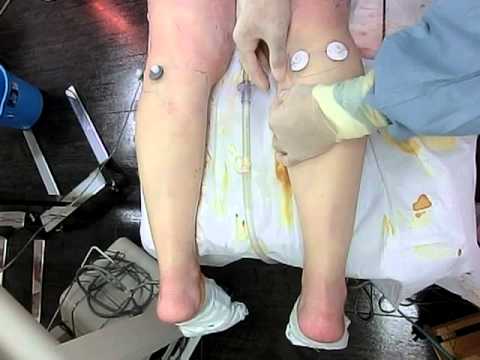 脂肪 吸引 手術