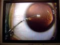 ICL Eye Surgery Part 2 of 5