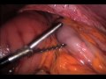 Hiatal Hernia Laparoscopic Correction After Esophagus Excision Hiatal Hernia Laparoscopic Correction After Esophagus Excision