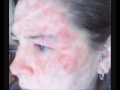 Journée mondiale du lupus: vidéo de sensibilisation