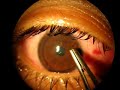 Reposicionar Colgajo LASIK Reposicionar Colgajo LASIK