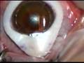 Lasik Eye Surgery