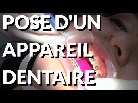 Pose bagues dentaires adulte