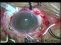 endoftalmitis.wmv