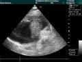 Thrombosis In Right Atrium In Doppler Echocardiography Thrombosis In Right Atrium In Doppler Echocardiography