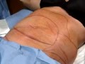 Dr.Solomon performs Liposuction