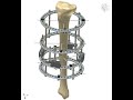 Correction of Torsion Deformity in Tibia  by Ilizarov Device