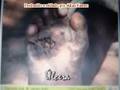 Nocoes basicas de Hanseniase (Lepra)