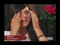 Face Lift, Chemical Peel, Chin Implant, Dr. Cruise, OC Face Lift, Chemical Peel, Chin Implant, Dr. Cruise, OC