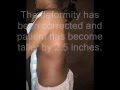  Kyphosis Of Lumbar And Thoracic Spine with Mucopolysaccharoidosis