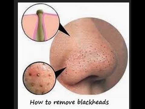 how to remove blackheads