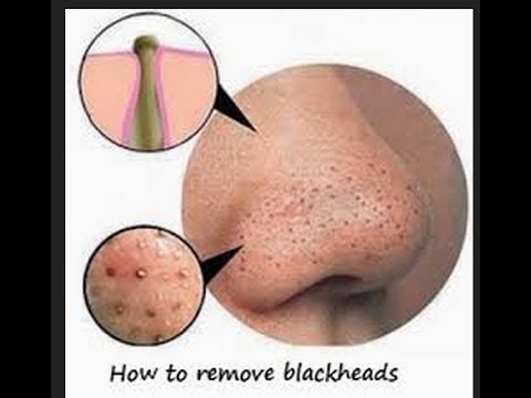 how to avoid blackheads
