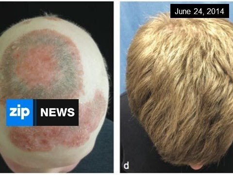 how to grow hair on head when it is bald