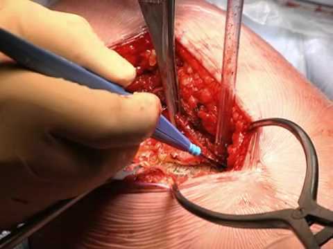 how to harvest tensor fascia lata
