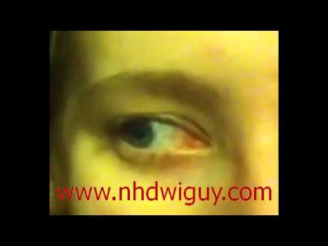 how to properly administer hgn test