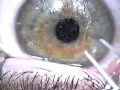LASIK Flap Disintegrates Upon Lifting for Enhancement LASIK Flap Disintegrates Upon Lifting for Enhancement