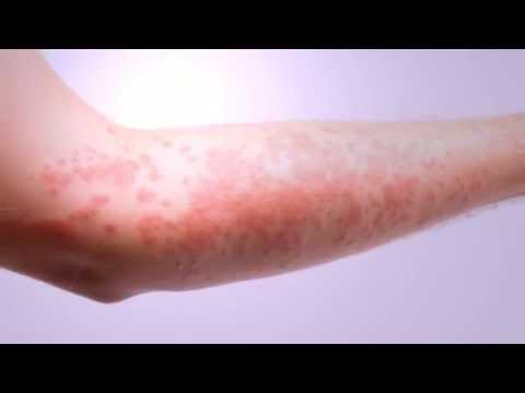 how to relieve itch from hfmd
