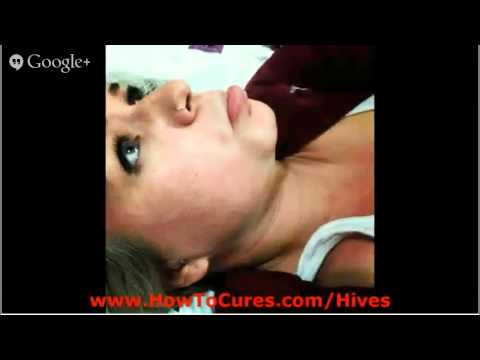 how to relieve urticaria