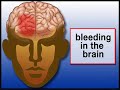 Seizures can result from strokes. Learn more about the relationship between these two common conditions. More Epilepsy videos: www.Healthguru.com