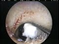 Lateral Tympanoplasty Lateral Tympanoplasty
