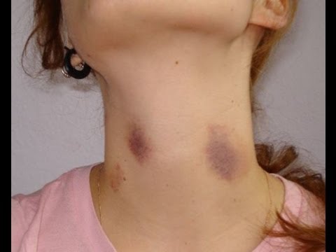 how to make a purple bruise go away