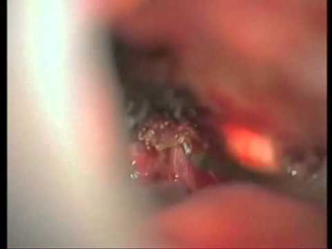 Lateral Supraorbital Access For TSM - Part 1