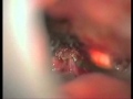 LSO for Tuberculum Sellae Meningioma Video 1