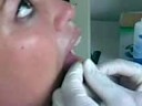 perforacion de sindy