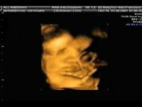 3D/4D Ultrasound (Muhammed)
