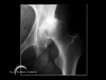 Birmingham Mid Head Resection (BMHR) Dysplasia Part 1